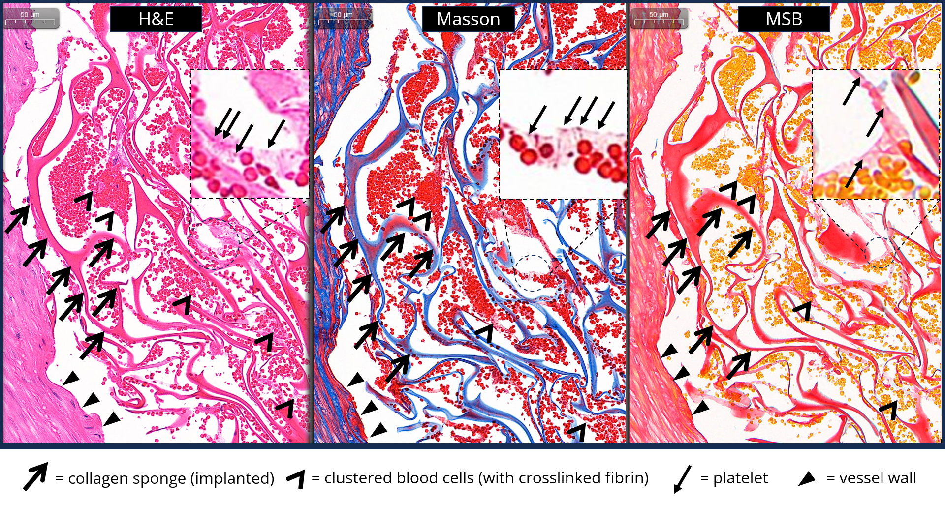 Expansible collagen sponge